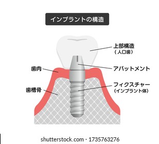 Dental implant flat vector illustration. Translation: Gum, Jaw bone, Crown(Artificial teeth), Abutment, Implant(Fixture).