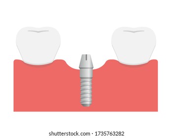 Dental implant flat vector illustration / Attach abutment
