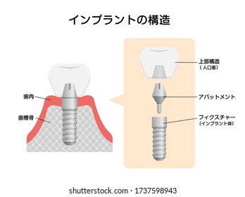 Dental implant flat vector illustration. Translation: Gum, Jaw bone, Crown(Artificial teeth), Abutment, Implant(Fixture)