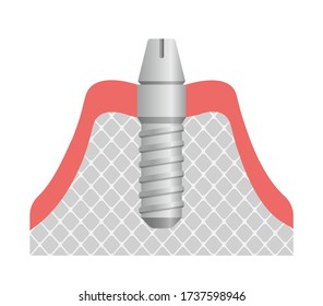 Dental implant flat vector illustration / Attach abutment