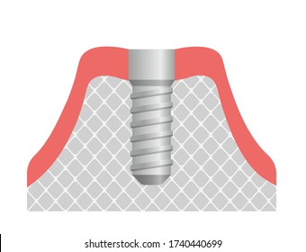 Dental implant flat vector illustration. implant in jaw bone