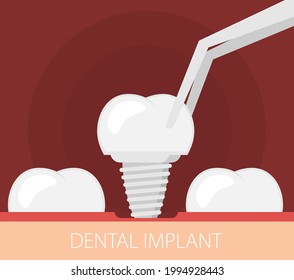 Dental implant flat vector style