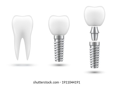 Dental implant, healing abutment, cap, crown. Artificial tooth, stages of implantation. Orthopedic, surgical treatment of missing teeth. Stomatological realistic vector illustration isolated on white.