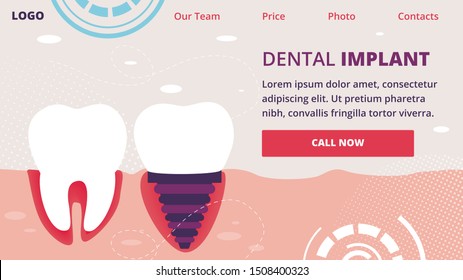 Dental Implant Horizontal Banner. Healthy Tooth and Implanted Structure with All Parts as Crown, Abutment, Screw in Human Jaw. Stomatology Orthodontics Procedure. Cartoon Flat Vector Illustration