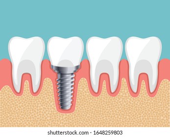 Dental Implant and Human teeth, Vector illustration. tooth