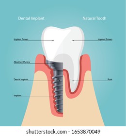 Dental Implant and Human teeth, Vector illustration. tooth