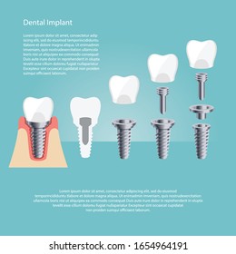 Dental Implant and Human teeth, Vector illustration. tooth