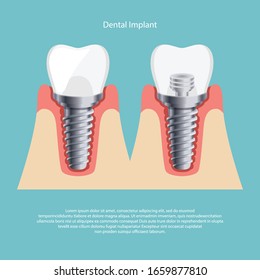 Dental Implant and Human teeth, Vector illustration. tooth