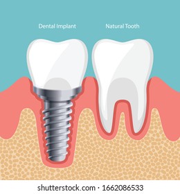 Dental Implant and Human teeth, Vector illustration. tooth