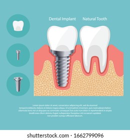 Dental Implant and Human teeth, Vector illustration. tooth