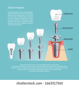 Dental Implant and Human teeth, Vector illustration. tooth