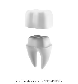 Dental implant illustration mockup