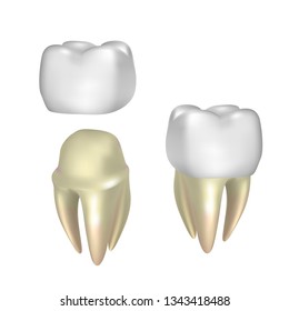 Dental implant illustration mockup