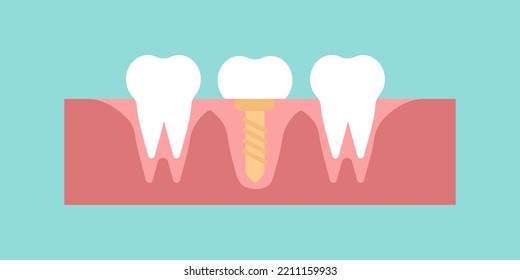 Dental Implant illustration, Tooth pin, Prosthetic dentistry image. Dental Care. Vector flat design illustration. Tooth implant	
