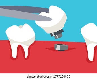 Dental Implant installation by doctor. Flat vector illustration in cartoon style. 