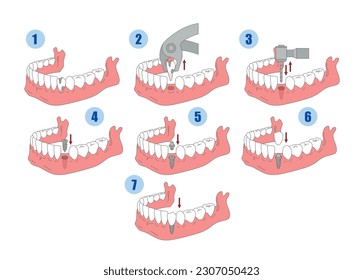 Dental implant installation process stages educational scheme isometric vector illustration. Dentistry surgical treatment human jaw care teeth replacement and fixation orthodontist cavity prosthesis