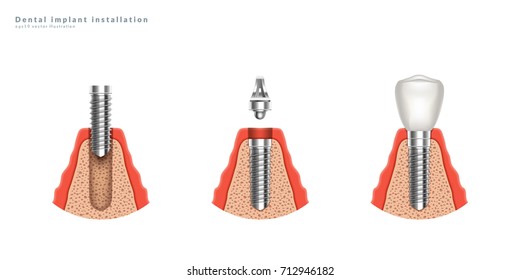 Dental implant installation stages. 3d realistic illustration. Eps10 vector.