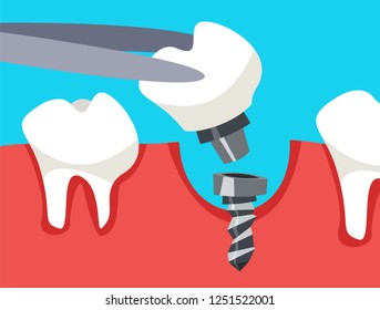 Dental implant installs by Doctor. Healthy teeth and dental prosthesis. Flat vector illustration in cartoon style.