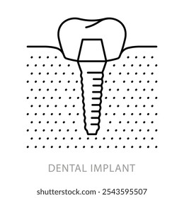 Dental implant, line icon.  Molar replacement for implant with crown. Linear illustration, editable stroke. Minimalist pictogram for dentistry.