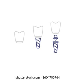 Dental implant line. Infographic poster. Human teeth icon. Crown and screw. For dental clinic. Dentistry outline vector illustration. White background.