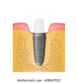 Dental implant, location and attachment of the implant in the mouth