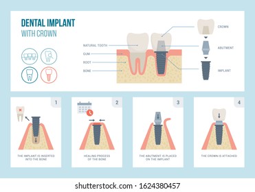 Dental implant medical procedure and structure, dentistry and orthodontics concept