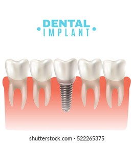 Dental implant model closeup cut away side view educative medical poster vector illustration 