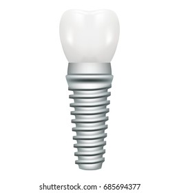 Dental Implant Model Closeup Cut Away Side View Educative Medical Poster Isolated On A White Background. Vector Illustration. Stomatology. Creative Medical Concept