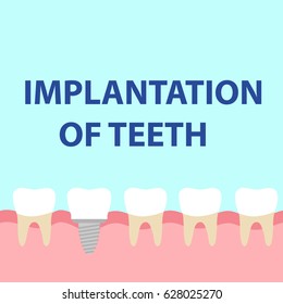 Dental implant model. Flat design, vector illustration, vector.