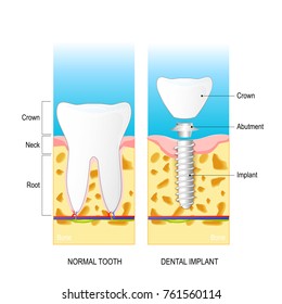 Dental Implant. Normal Human Tooth And Prosthesis. Dental Anatomy: Root, Neck, Crown. Structure Of Dental Implant: Crown, Abutment And Implant. Vector Diagram For Medical Use