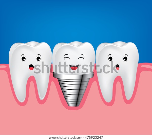 Vector De Stock Libre De Regalias Sobre Implante Dental Y Diente Normal Hermoso