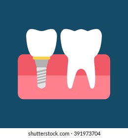 A dental implant and a normal tooth. Flat vector illustration isolated on blue background