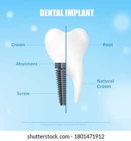 Dental implant and normal tooth medical dentistry or stomatology banner template, realistic vector illustration. Infographics of tooth implant installation.