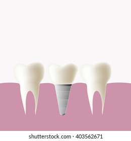 Dental implant and normal tooth, Vector  illustration.