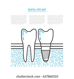 A dental implant is painted in a flat linear style, vector illustration isolated on white background