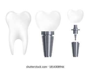 Dental implant parts - realistic white tooth with titanium metal screw attached to ceramic crown. Dentistry prosthesis divided into elements, isolated vector illustration.