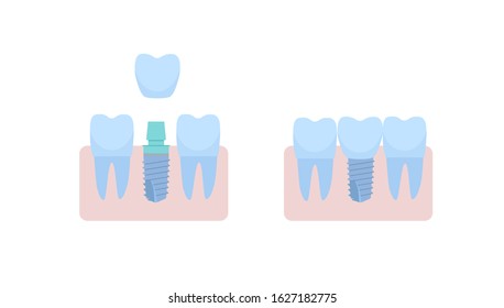 A dental implant placed between two healthy teeth, the abutment is covered with a crown. ivector illustration, in a flat style with a thin line. Inside the oral cavity, the gums, the roots.