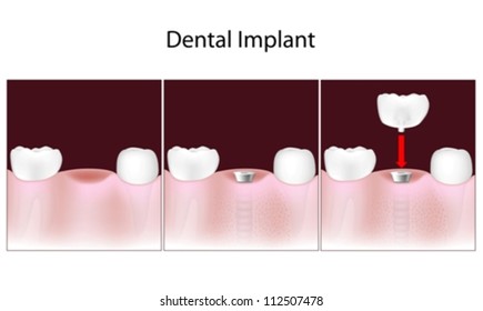 Dental implant procedure