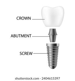 Dental implant. Realistic implant structure, graphic models of the crown. Screw prosthesis, orthodontic dental implantation