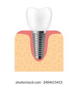 Dental implant. Realistic implant structure, graphic models of the crown. Screw prosthesis, orthodontic dental implantation