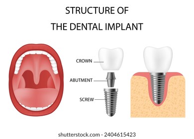 Implante dental. Estructura implante realista, modelos gráficos de la corona. prótesis de tornillo, implantación dental ortodoncia