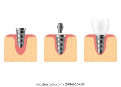 Zahnimplantat. Realistische Implantatstruktur, grafische Modelle der Krone. Screenprothese, orthodontische Zahnimplantation