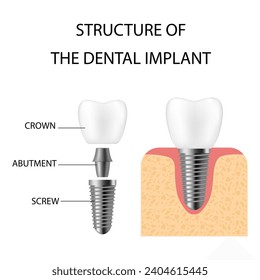 Dental implant. Realistic implant structure, graphic models of the crown. Screw prosthesis, orthodontic dental implantation