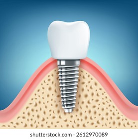 Dental implant schematic close-up. Vector illustration.