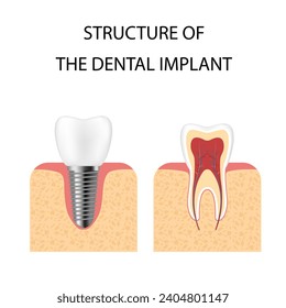 Dental implant. Screw prosthesis, orthodontic dental implantation