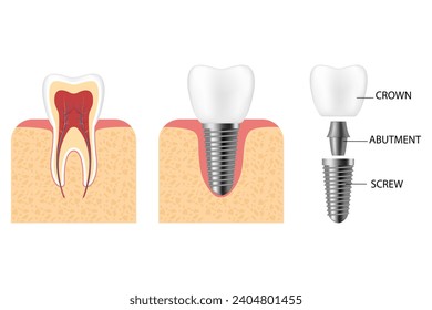 Dental implant. Screw prosthesis, orthodontic dental implantation