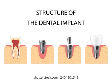 Dental implant. Screw prosthesis, orthodontic dental implantation