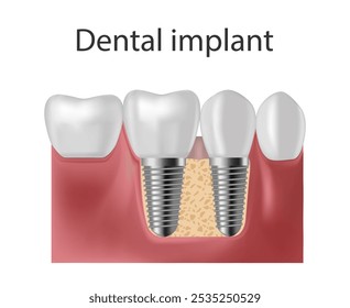 Implante dentário. Prótese de parafuso, implante dentário ortodôntico