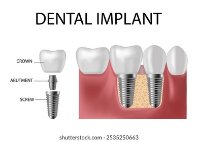 Implante dentário. Prótese de parafuso, implante dentário ortodôntico