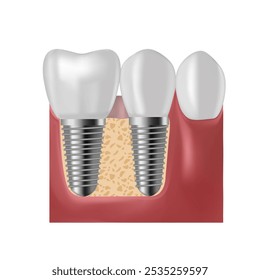 Implante dentário. Prótese de parafuso, implante dentário ortodôntico